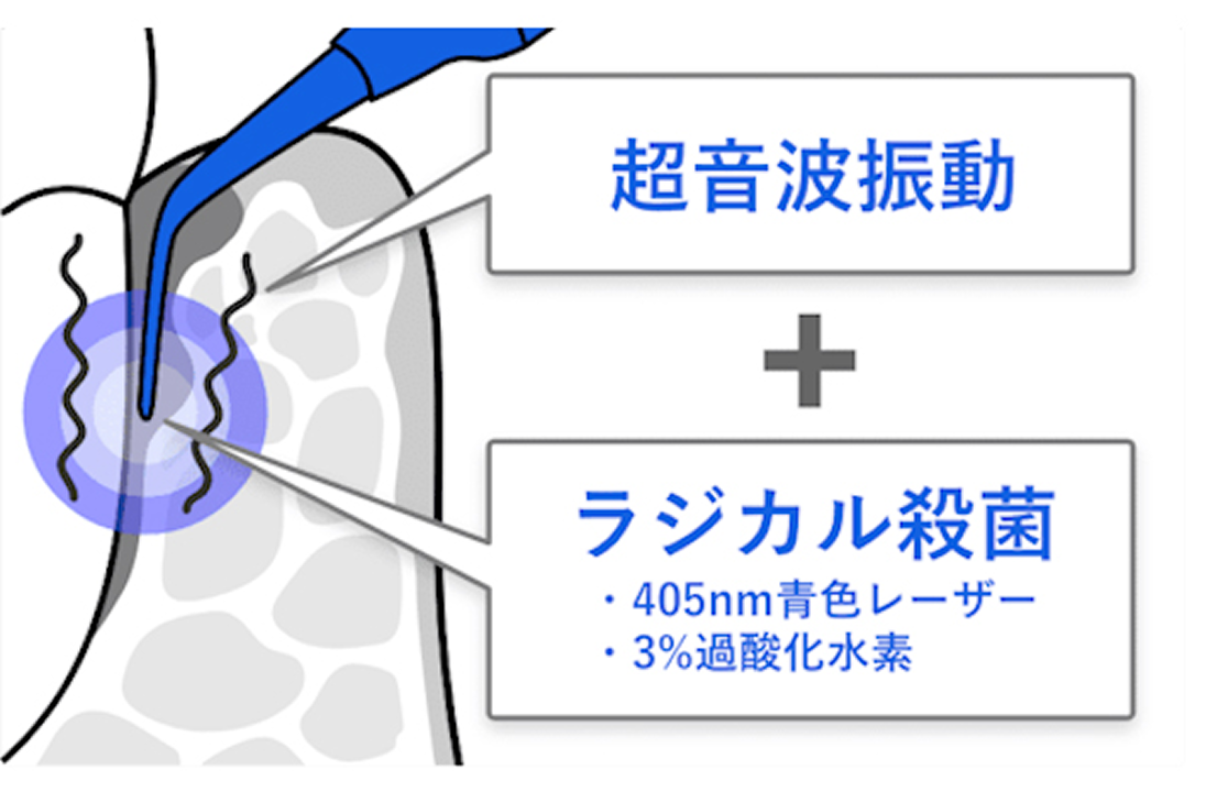 ブルーラジカル